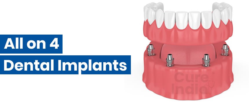 Full-All on 4 Full Mouth Dental Implants